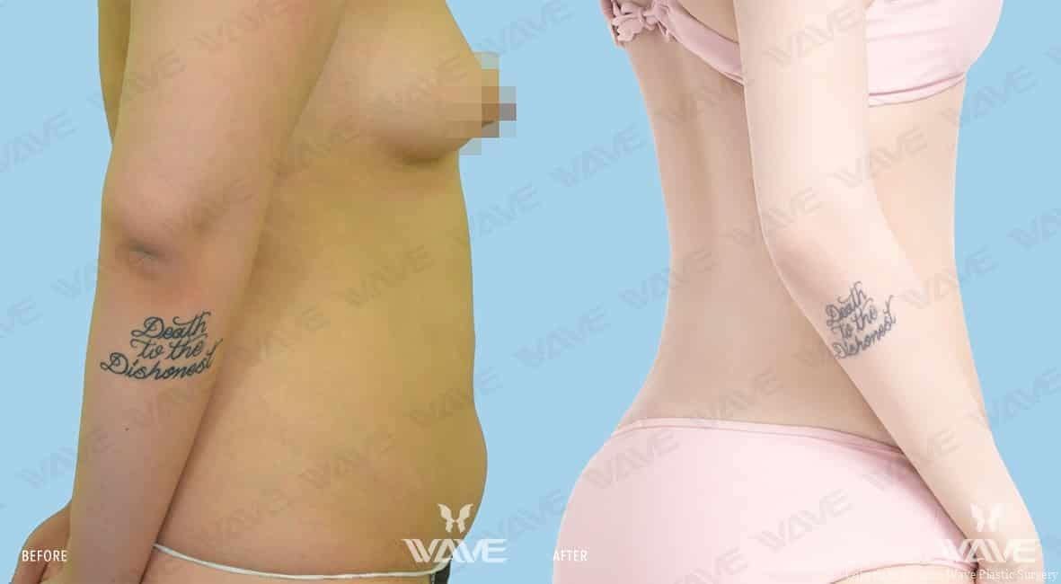 Before and after photo at Wave Plastic Surgery