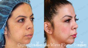 Endoscopic Mid Face Lift Before and After Photo